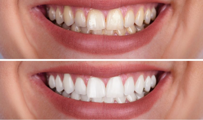 Teeth Whitening Las Vegas